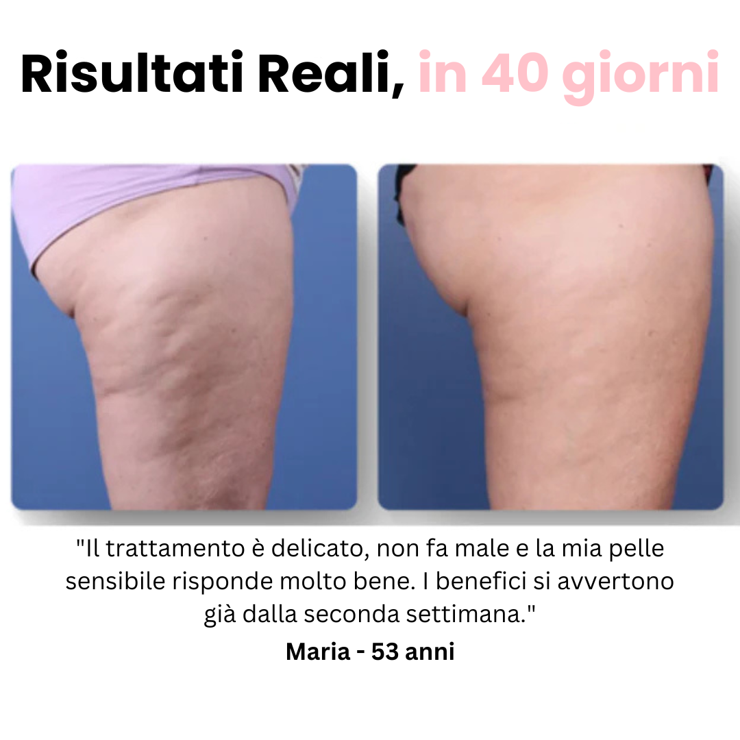 Velora™ - Masajeador anticelulítico