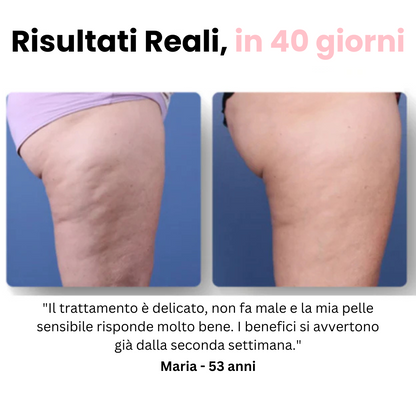 Velora™ - Masajeador anticelulítico